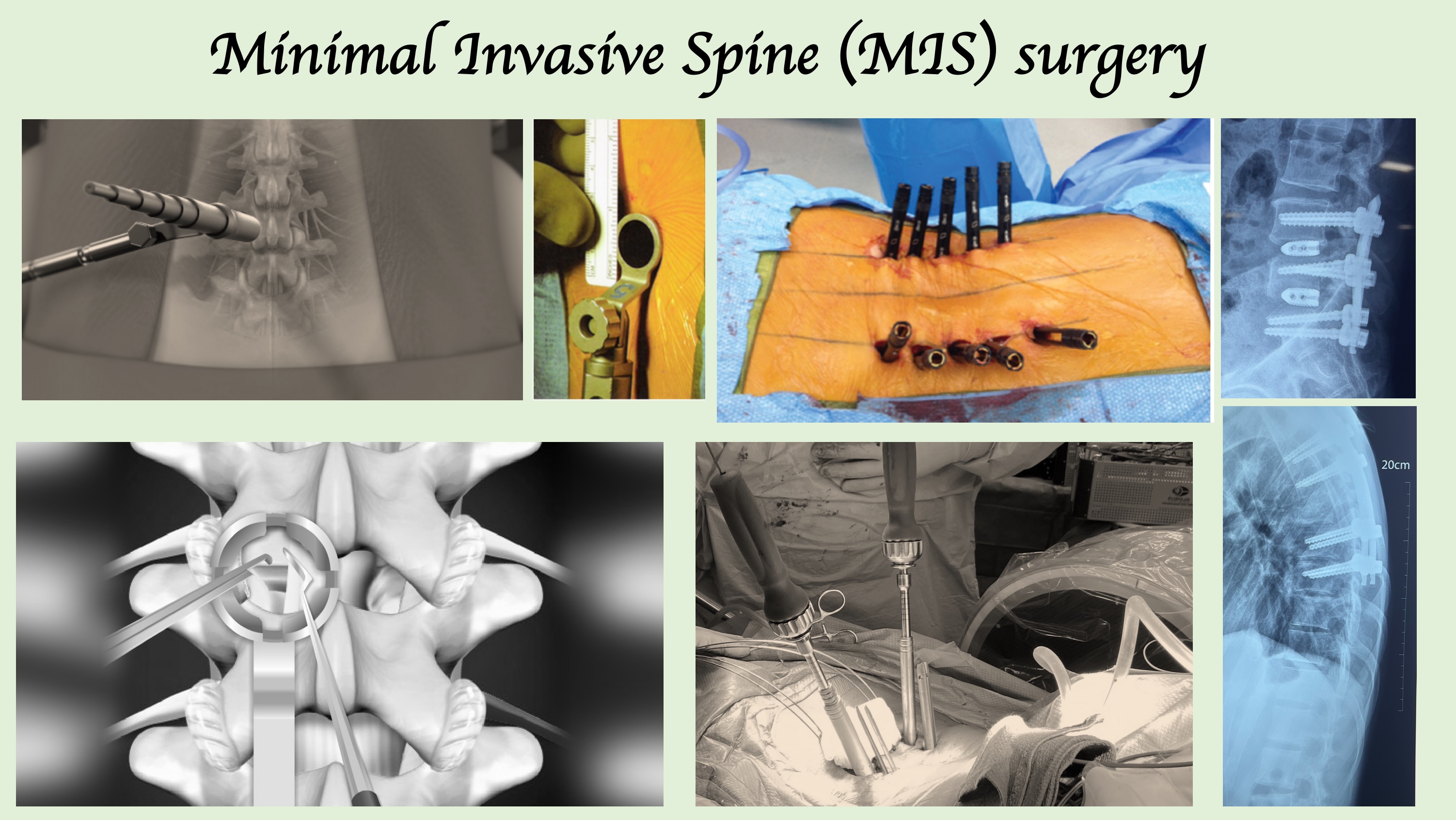 Minimally Invasive Spine (MIS) Surgery