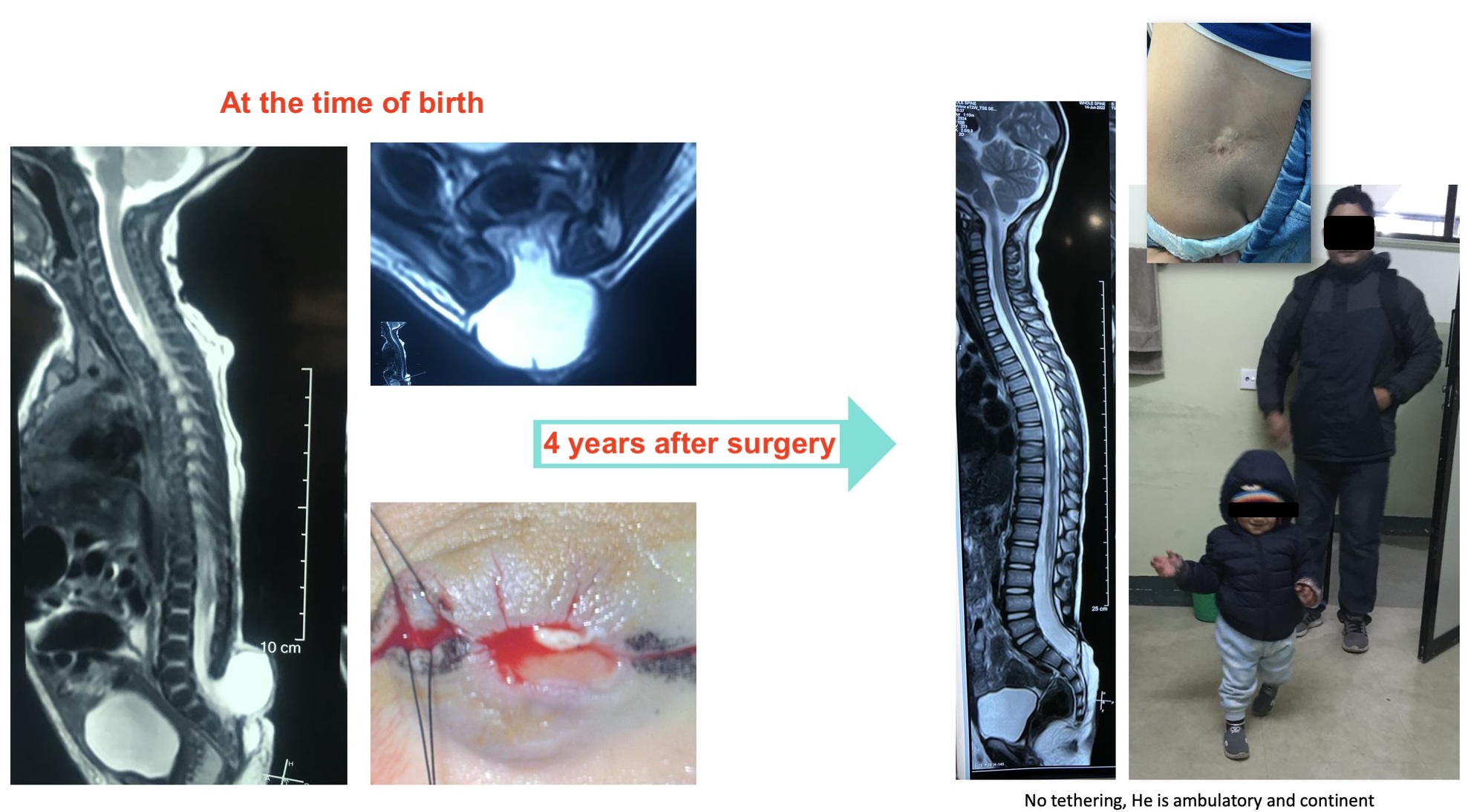 Pediatric Neurosurgery 